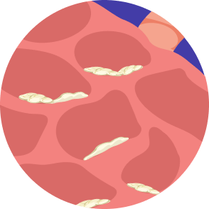 Microscopic illustration of squamous cell carcinoma lung cancer, located in the center of the lungs.