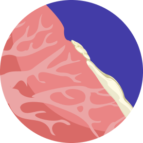 Microscopic illustration of adenocarcinoma lung cancer, that shows tumors that produce a mucus-like substance within the glands lining the inside of the lungs.