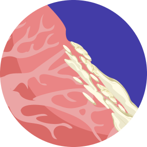 Microscopic illustration of large cell carcinoma which shows abnormal cells growing in the lungs.